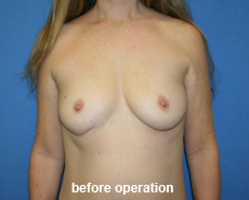 plastic-surgery-breast-augmentation